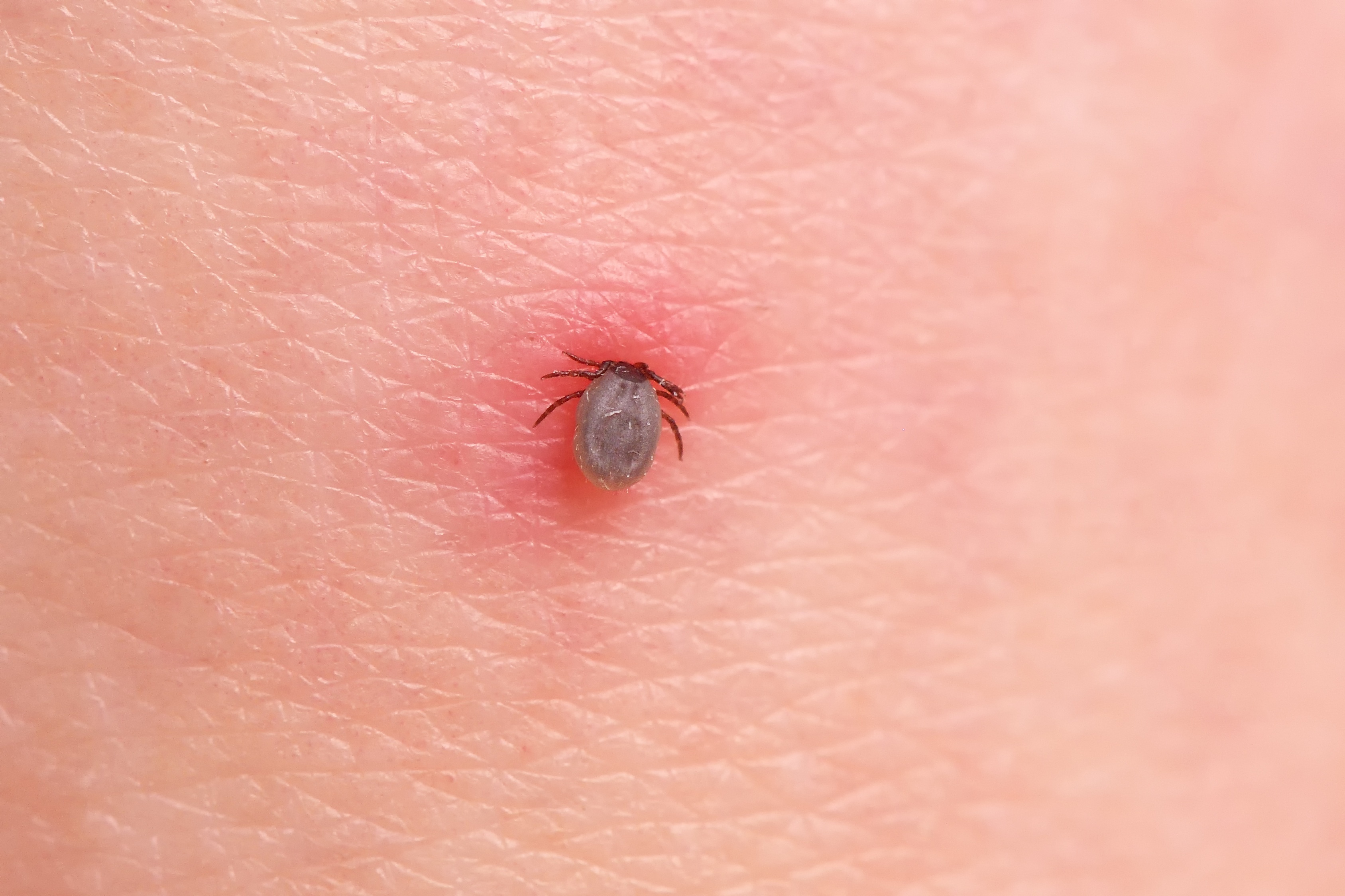 Как самостоятельно вытащить клеща